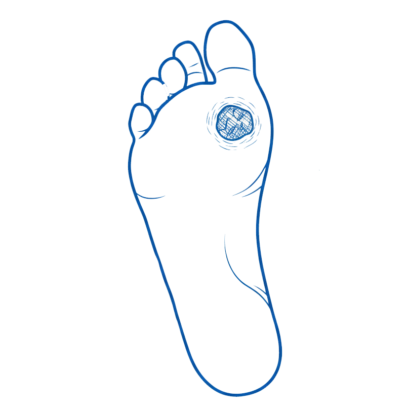 Diabetiese Voetulkus